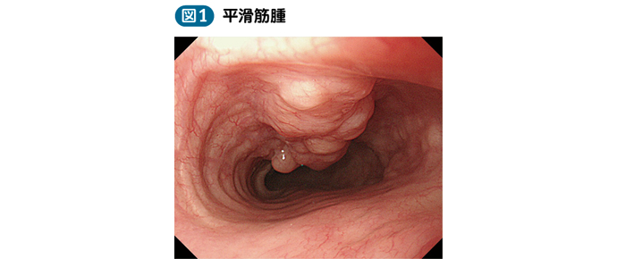 05_06_食道良性腫瘍