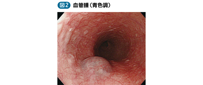 05_06_食道良性腫瘍