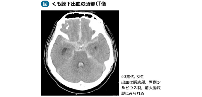 08_04_くも膜下出血