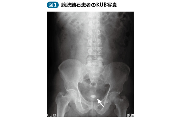 16_12_下部尿路結石