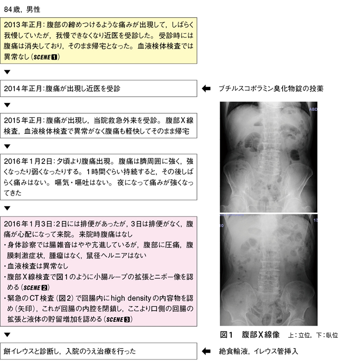 お餅イレウス 難渋症例から学ぶ診療のエッセンス 1 Web医事新報 日本医事新報社