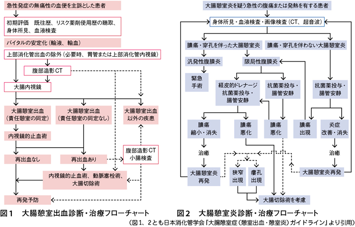 炎 原因 憩室 大腸