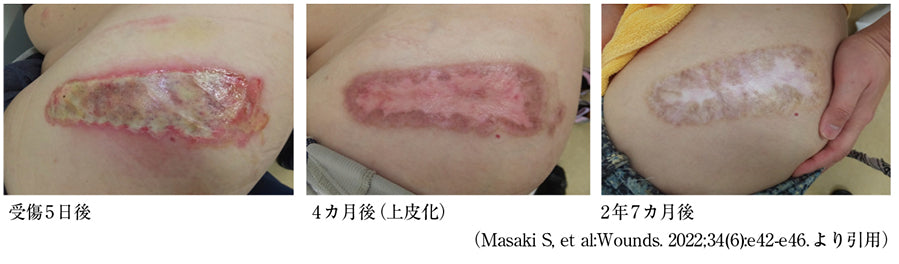 Ⅲ度熱傷を家で治したい（真崎茂法）［プラタナス］