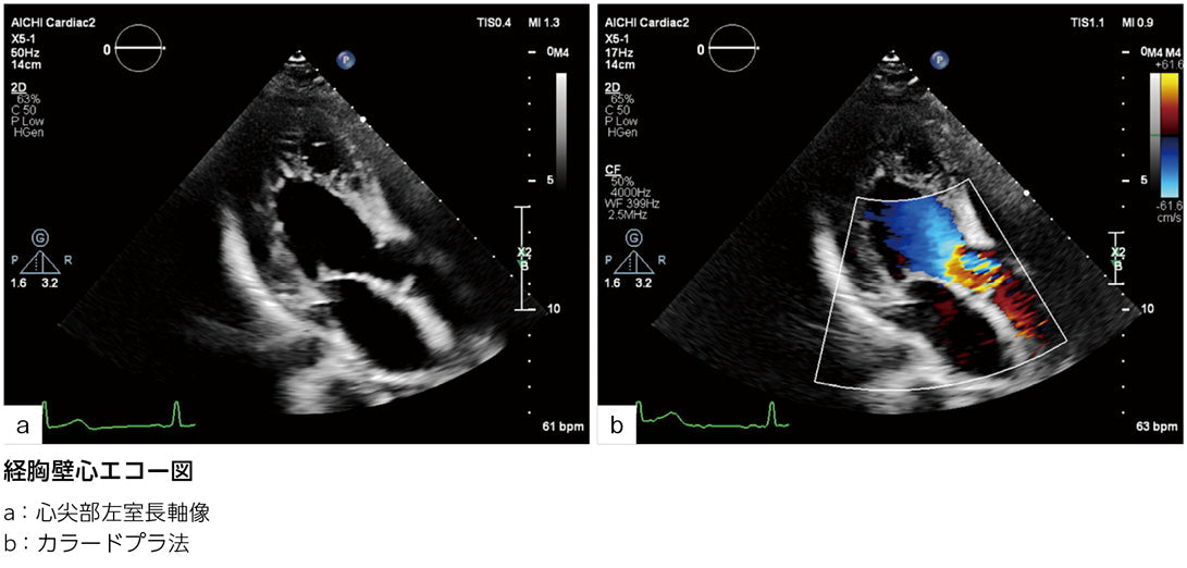 左室流出路狭窄の原因は？［画像診断道場～実はこうだった（326）］