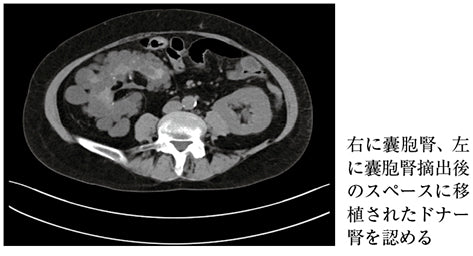 生体腎移植—レシピエント・ドナー夫婦の生涯医療（酒井 謙）［プラタナス］