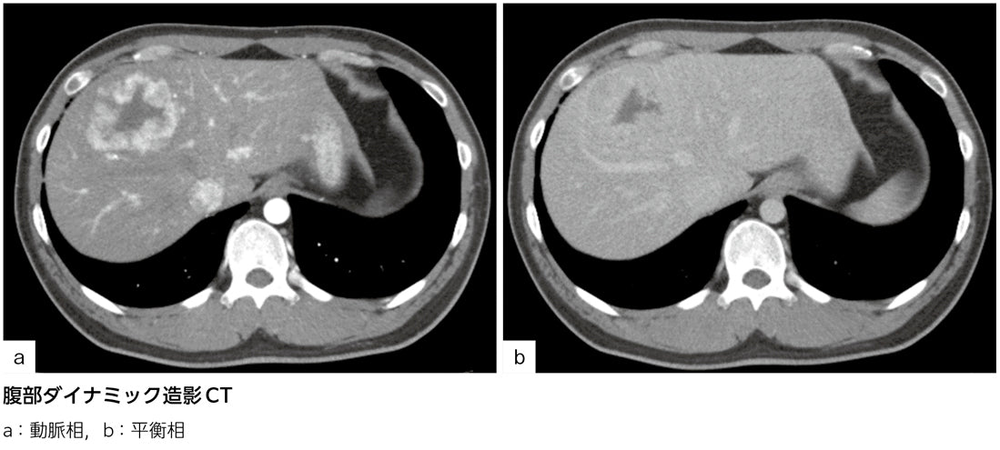 多血性腫瘍……診断は？［画像診断道場～実はこうだった（327）］