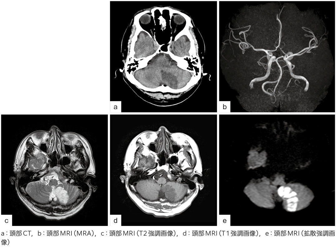 小脳梗塞？　その原因は？［画像診断道場～実はこうだった（328）］