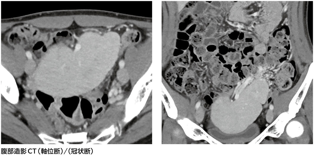 骨盤内腫瘍？それとも……［画像診断道場～実はこうだった（329）］
