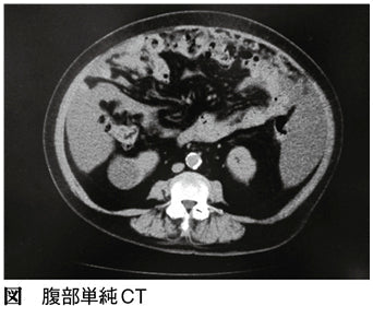 末期がんでホスピスを紹介された癌性腹膜炎の患者さん～治療可能ながんを見逃さないで～（勝俣範之）［プラタナス］