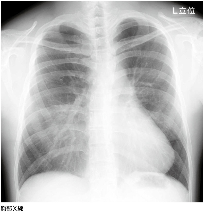 肺炎？　中葉無気肺？　……診断は？［画像診断道場～実はこうだった（330）］