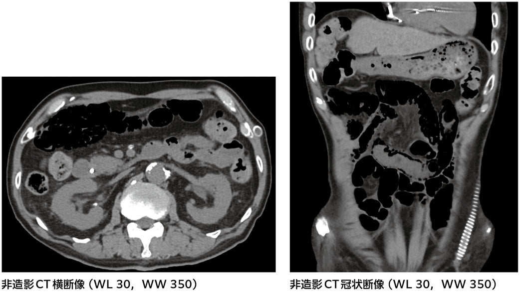 腹痛の原因は？［画像診断道場～実はこうだった（345）］
