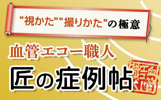 大動脈弁輪拡張症（AAE）［血管エコー職人 匠の症例帖〜“視かた”“撮りかた”の極意（20）］
