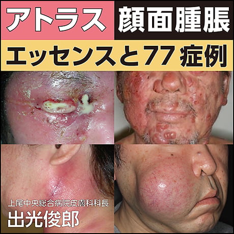 アトラス 顔面腫脹〜エッセンスと77症例