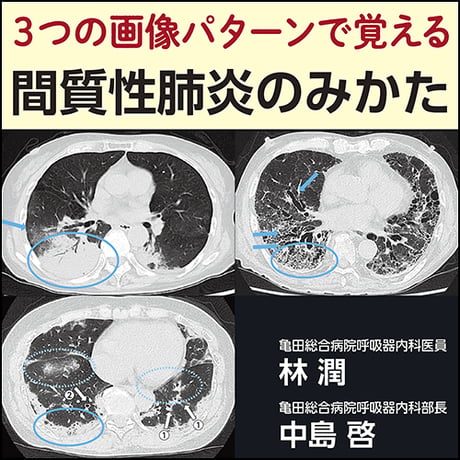 【裁断済み】症例から学ぶ 間質性肺炎の臨床・画像・病理 症例から学ぶ 間質性肺炎の臨床・画像・病理 | 田口善夫, 野間惠之