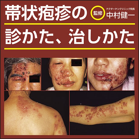 帯状疱疹の診かた、治しかた