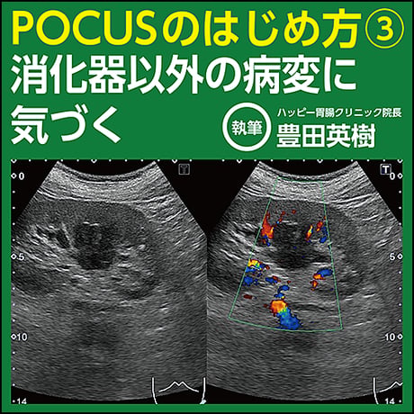 POCUSのはじめ方③〜消化器以外の病変に気づく