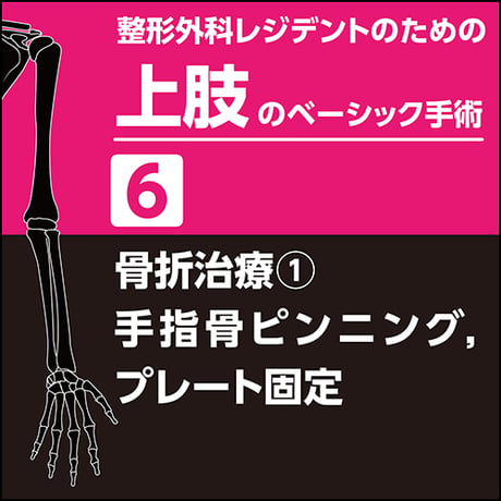 整形外科レジデントのための上肢のベーシック手術6　骨折治療1　手指骨ピンニング，プレート固定（PDF版）