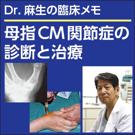 母指CM関節症の診断と治療〜Dr.麻生の臨床メモ