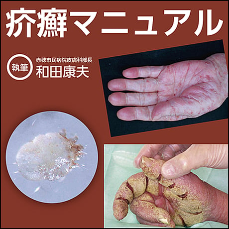疥癬マニュアル