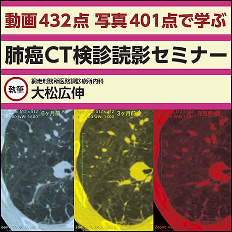 【動画432点 写真401点で学ぶ】肺癌CT検診読影セミナー