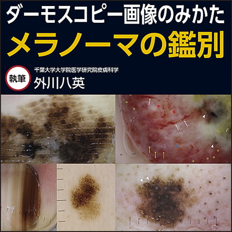 ダーモスコピー画像のみかた〜メラノーマの鑑別