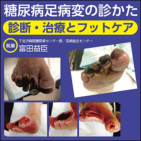 糖尿病足病変の診かた〜診断・治療とフットケア
