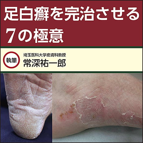 足白癬を完治させる7の極意