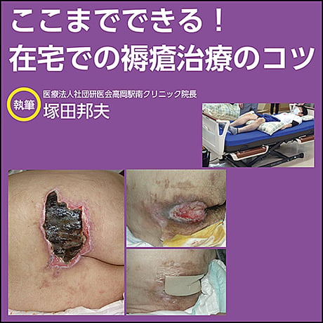 ここまでできる！ 在宅での褥瘡治療のコツ