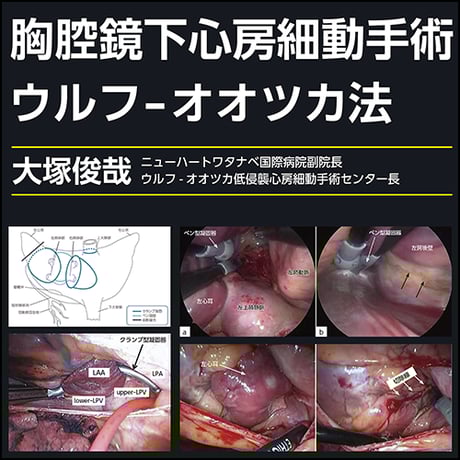 胸腔鏡下心房細動手術 ウルフ-オオツカ法