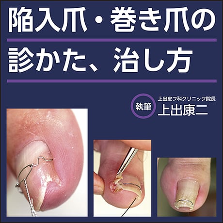 陥入爪・巻き爪の診かた、治しかた