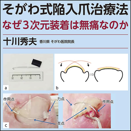 そがわ式陥入爪治療法〜なぜ3次元装着は無痛なのか