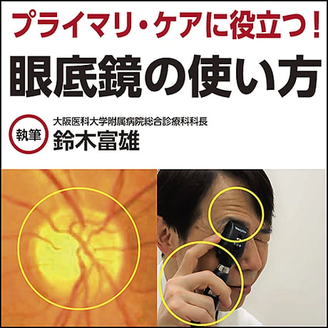 プライマリ・ケアに役立つ！眼底鏡の使い方