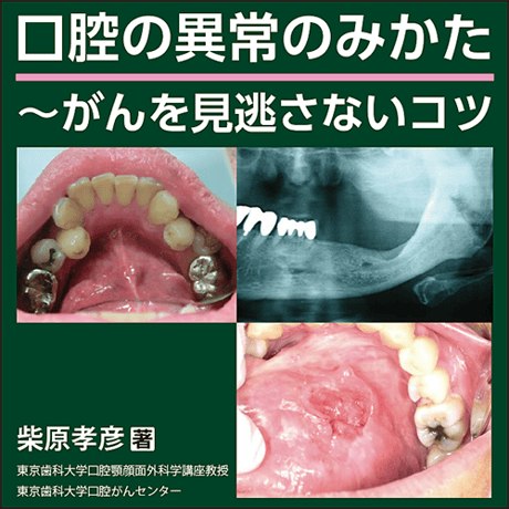 口腔の異常のみかた〜がんを見逃さないコツ