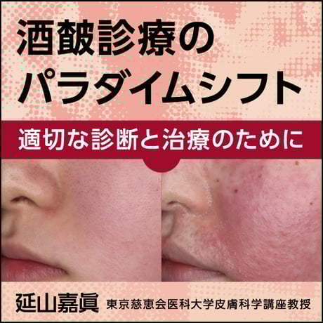 酒皶診療のパラダイムシフト―適切な診断と治療のために―