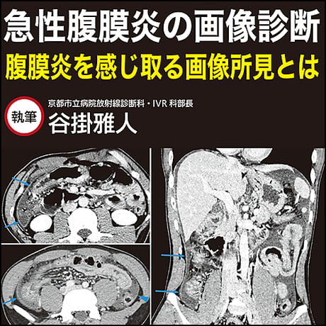急性腹膜炎の画像診断〜腹膜炎を感じ取る画像所見とは