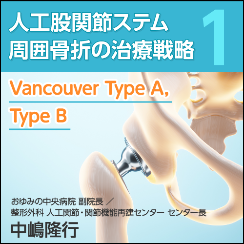 人工股関節ステム周囲骨折の治療戦略①〈Vancouver Type A，Type B〉