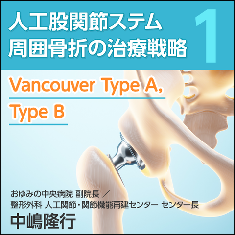 人工股関節ステム周囲骨折の治療戦略①〈Vancouver Type A，Type B〉