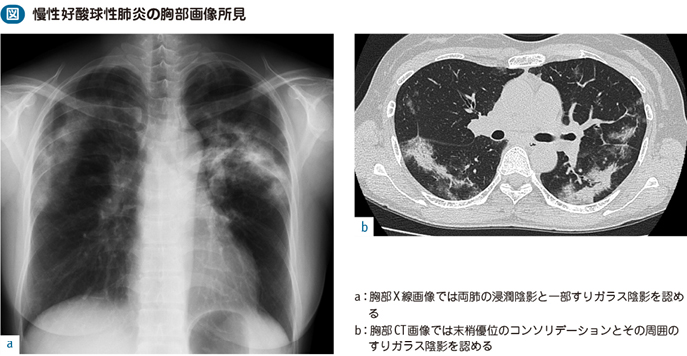 03_17_好酸球性肺炎