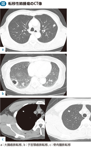 03_28_転移性肺腫瘍