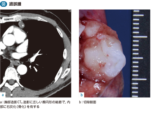 03_29_肺の良性腫瘍