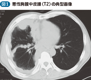 03_36_胸膜腫瘍（悪性胸膜中皮腫を含む）