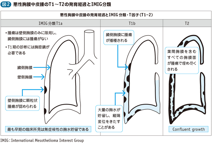 03_36_胸膜腫瘍（悪性胸膜中皮腫を含む）