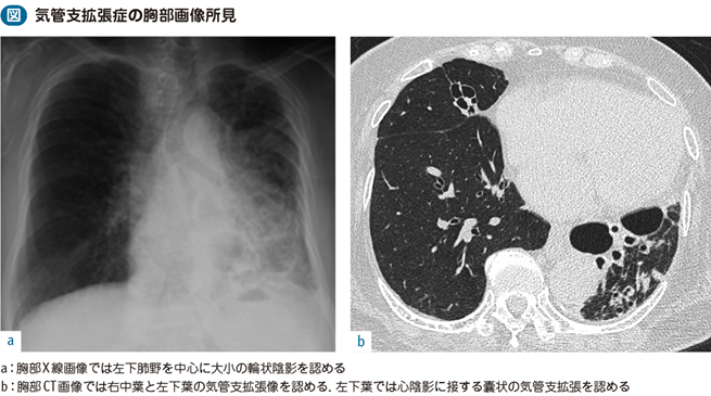 03_40_気管支拡張症