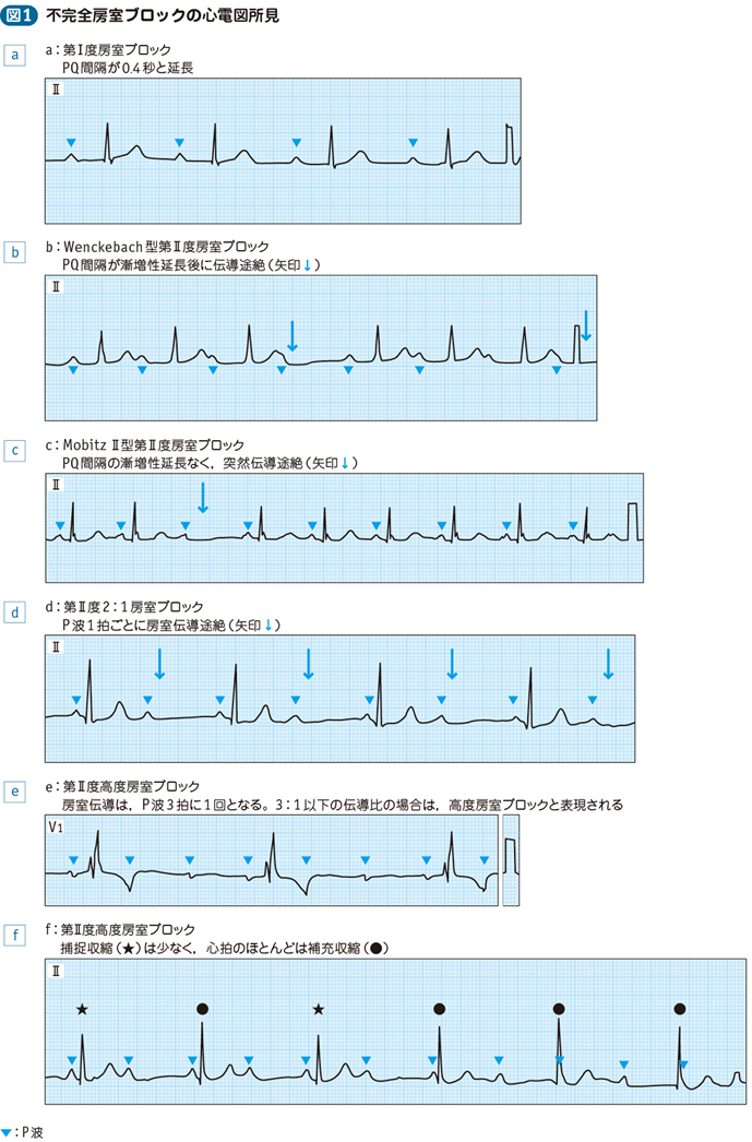 不完全房室ブロック電子コンテンツ日本医事新報社