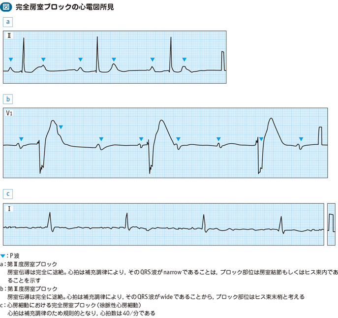 完全房室ブロック電子コンテンツ日本医事新報社