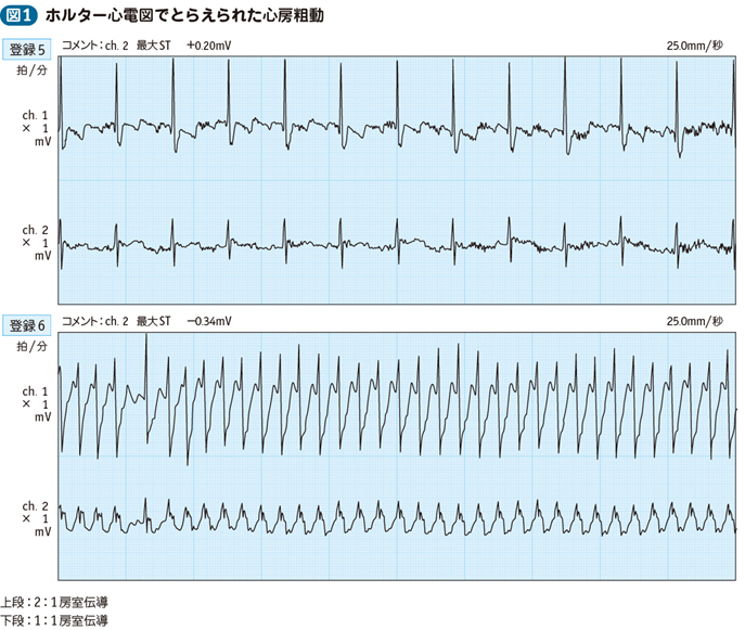 フラッター 心電図