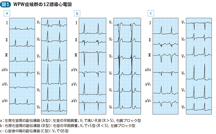 04_10_Wolff-Parkinson-White（WPW）症候群