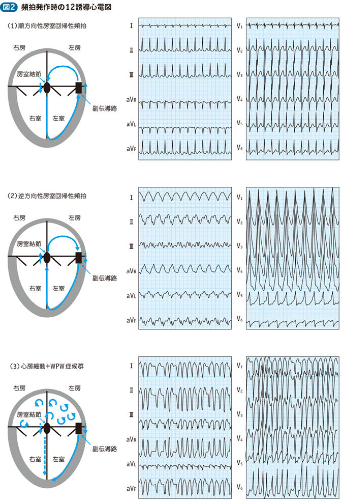 04_10_Wolff-Parkinson-White（WPW）症候群