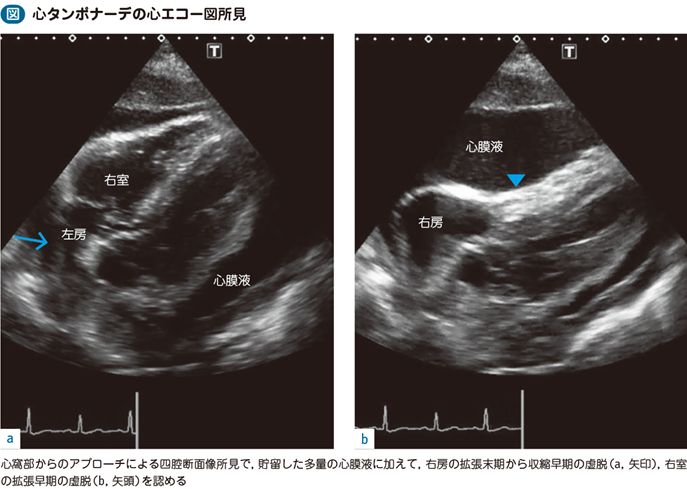 04_36_心タンポナーデ