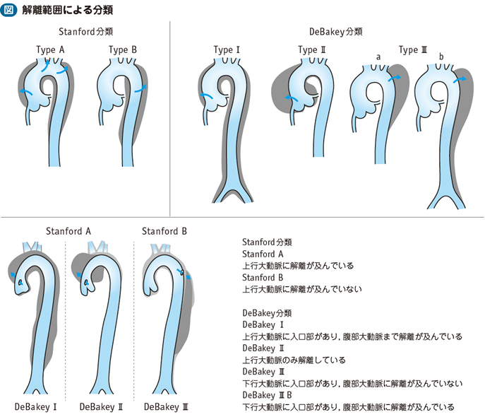 04_38_大動脈解離